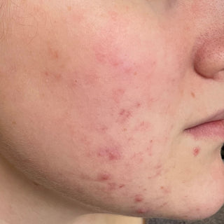 BTBS Blemish-Prone Skin Regimen | B+A Grid 3 Image File [Before]