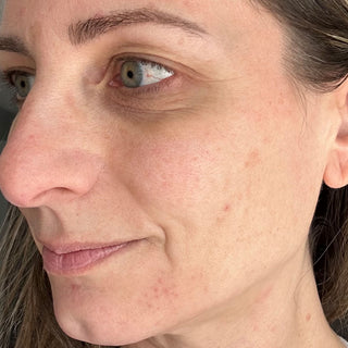 BTBS Hyperpigmented Skin Regimen Page | B+A Tile 2 Image File [Before]